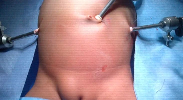 Paediatric Minimal Access Surgery